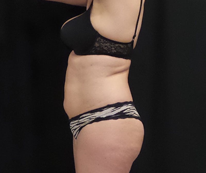 CoolSculpting Before & After Gallery - Patient 113563 - Image 3
