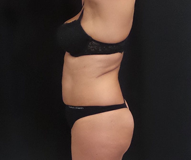 CoolSculpting Before & After Gallery - Patient 113563 - Image 4
