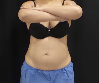 CoolSculpting Before & After Gallery - Patient 166693 - Image 1