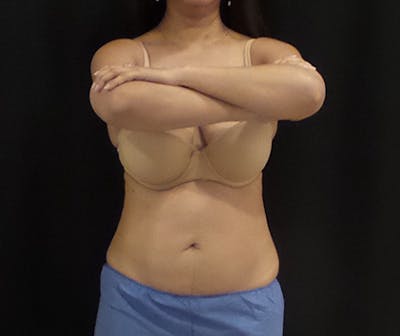 CoolSculpting Before & After Gallery - Patient 166693 - Image 2