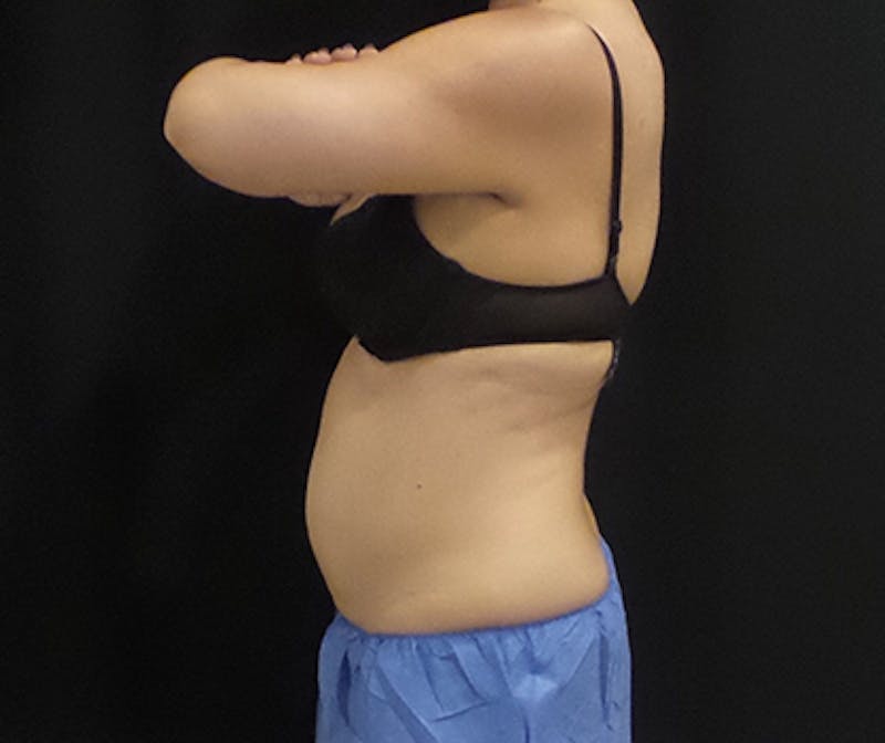 CoolSculpting Before & After Gallery - Patient 166693 - Image 3