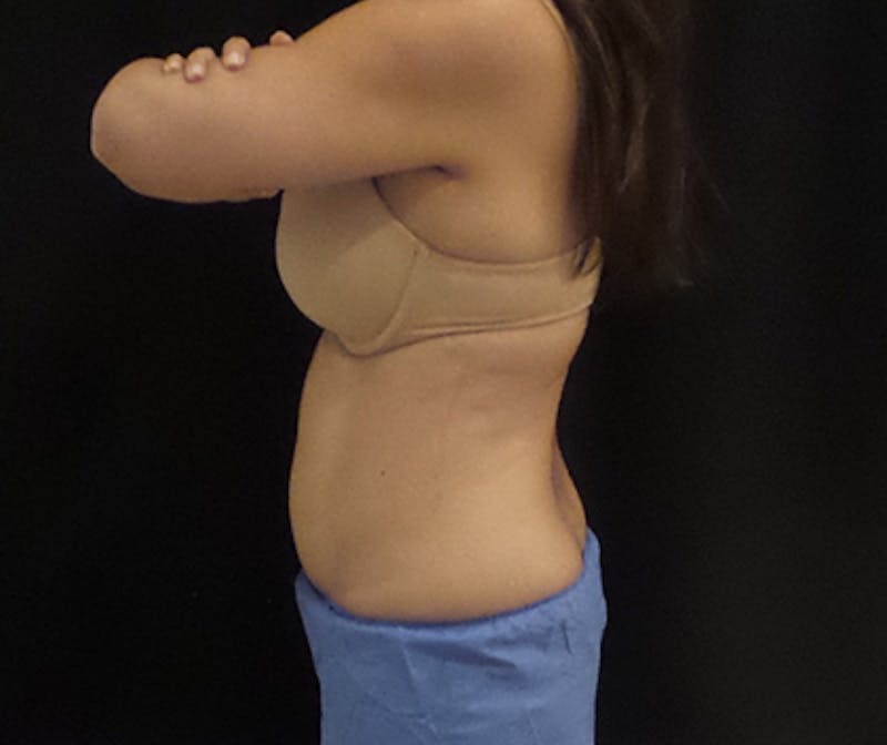 CoolSculpting Before & After Gallery - Patient 166693 - Image 4