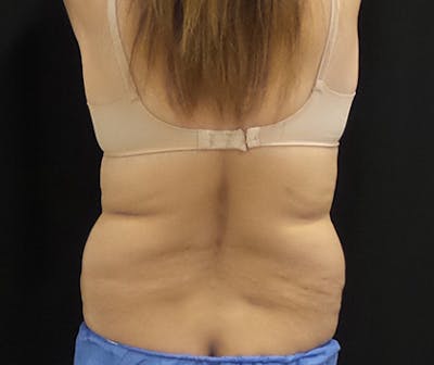 CoolSculpting Before & After Gallery - Patient 276310 - Image 1