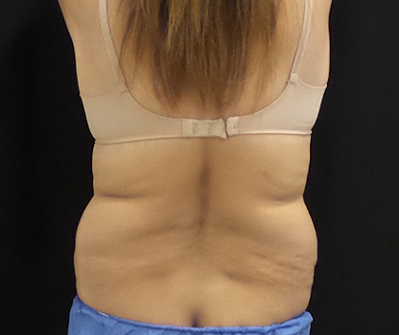 CoolSculpting Before & After Gallery - Patient 276310 - Image 1