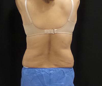 CoolSculpting Before & After Gallery - Patient 276310 - Image 2