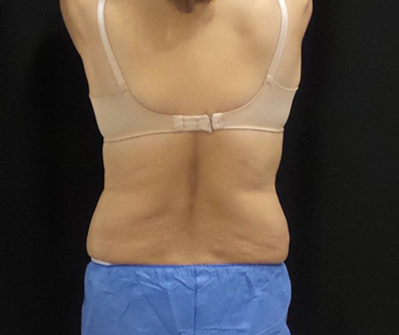 CoolSculpting Before & After Gallery - Patient 276310 - Image 2