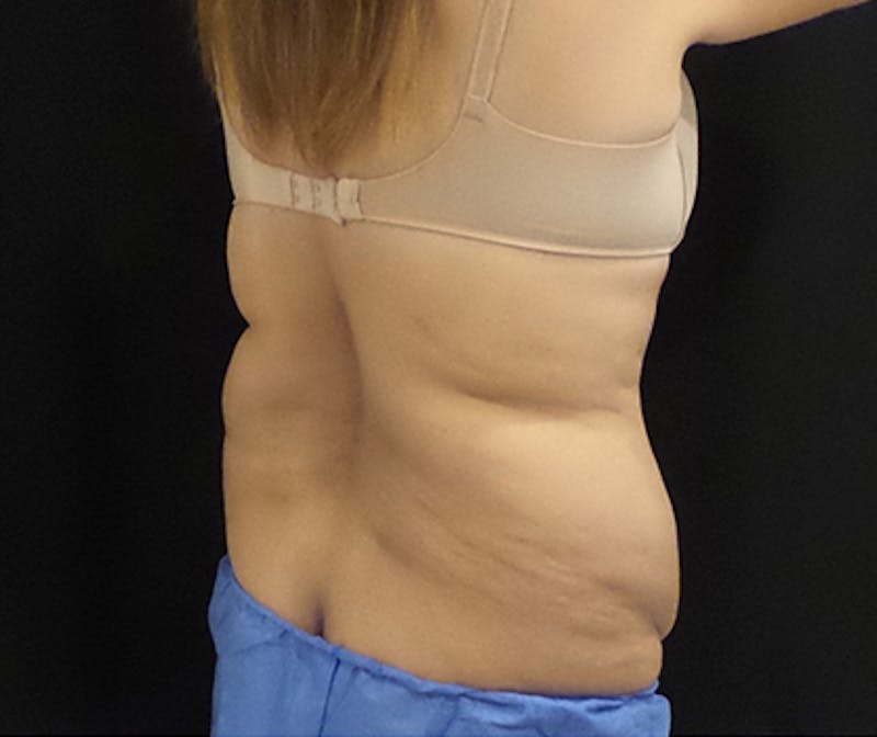 CoolSculpting Before & After Gallery - Patient 276310 - Image 3