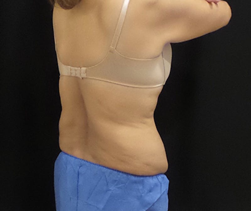CoolSculpting Before & After Gallery - Patient 276310 - Image 4