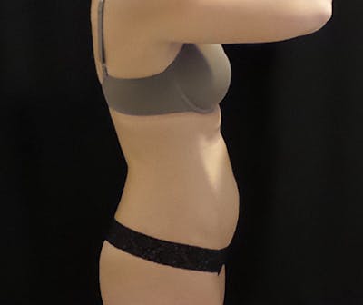 CoolSculpting Before & After Gallery - Patient 274715 - Image 1