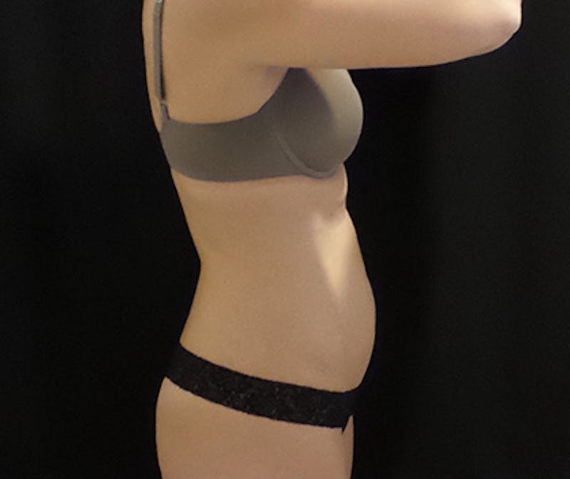 CoolSculpting Before & After Gallery - Patient 274715 - Image 1