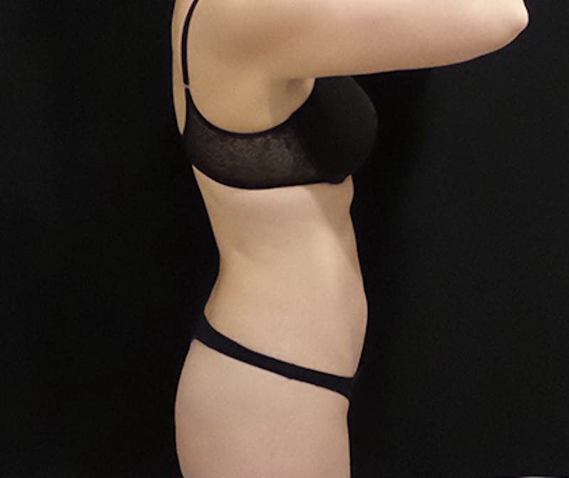 CoolSculpting Before & After Gallery - Patient 274715 - Image 2
