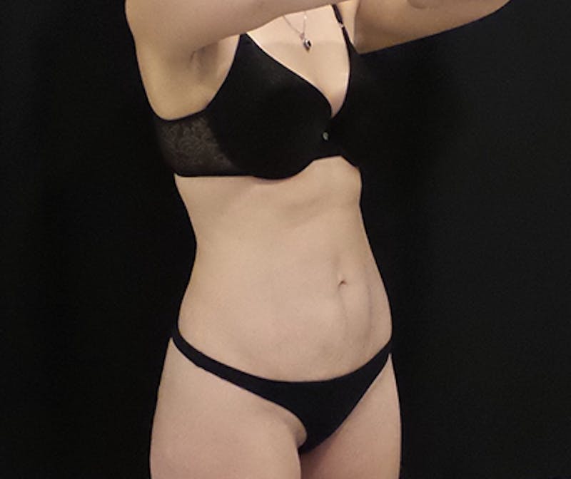 CoolSculpting Before & After Gallery - Patient 274715 - Image 4