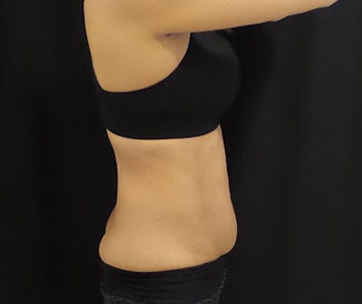 CoolSculpting Before & After Gallery - Patient 109137 - Image 1