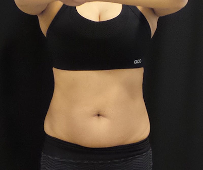 CoolSculpting Before & After Gallery - Patient 109137 - Image 3
