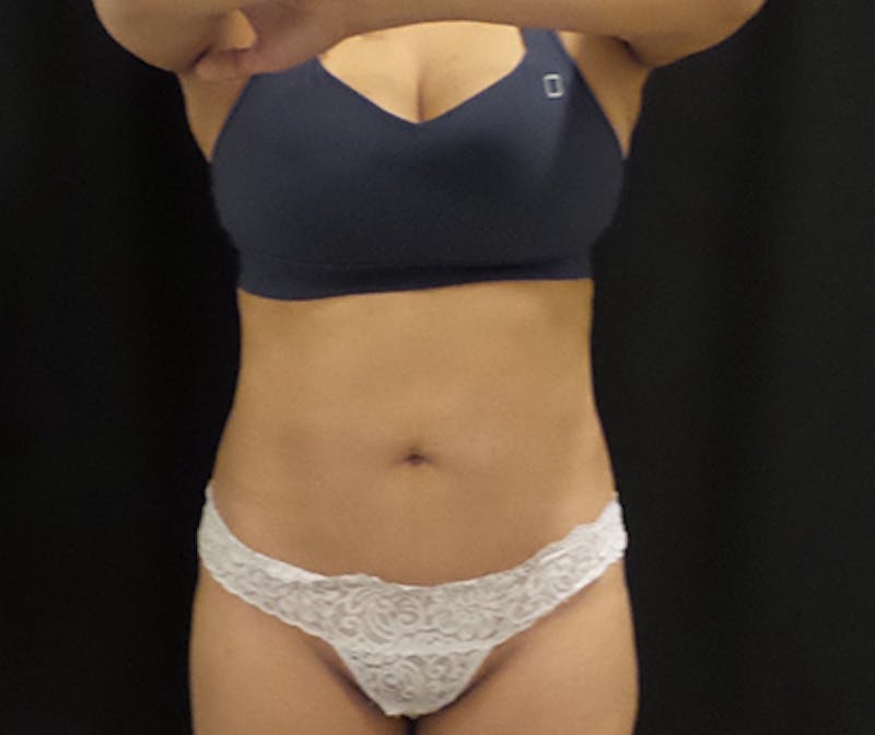 CoolSculpting Before & After Gallery - Patient 109137 - Image 4