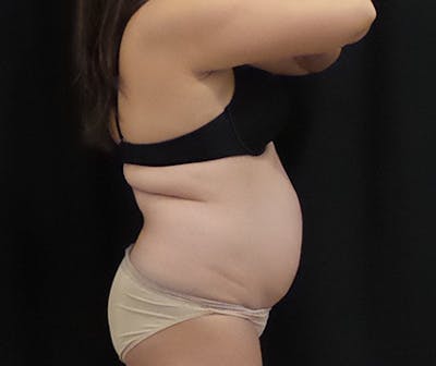 CoolSculpting Before & After Gallery - Patient 339088 - Image 1