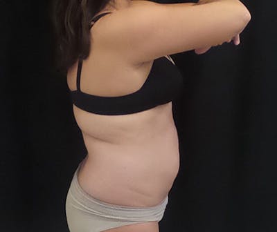 CoolSculpting Before & After Gallery - Patient 339088 - Image 2