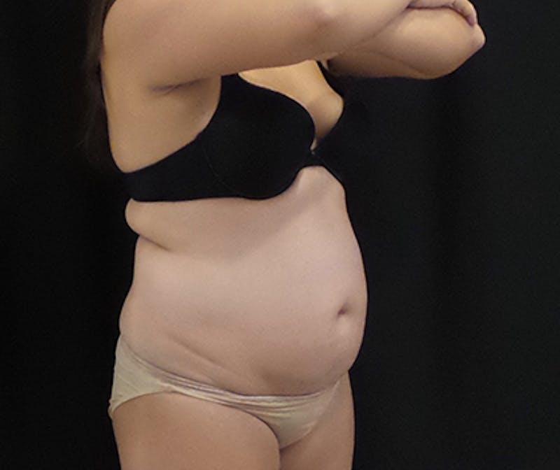 CoolSculpting Before & After Gallery - Patient 339088 - Image 3