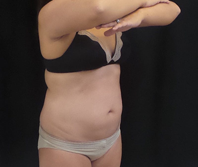 CoolSculpting Before & After Gallery - Patient 339088 - Image 4