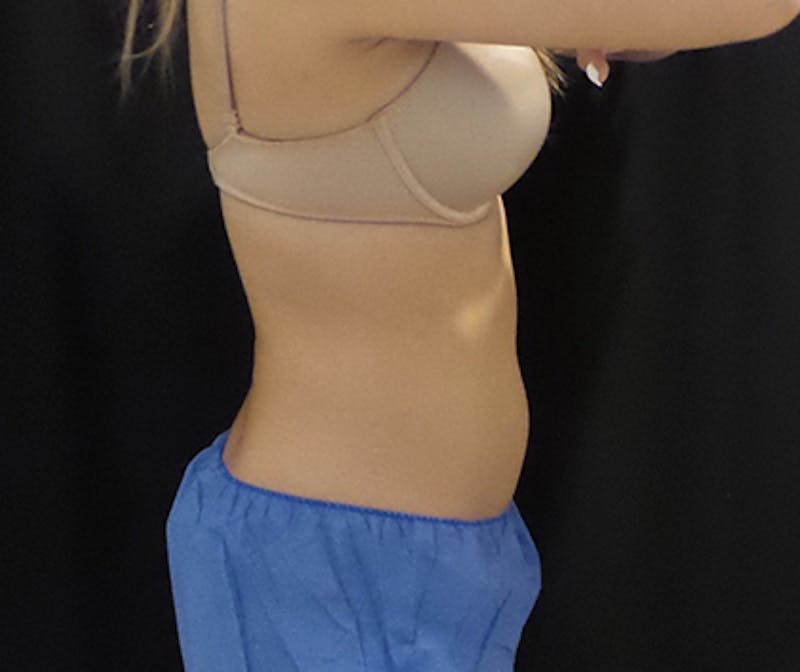 CoolSculpting Before & After Gallery - Patient 191796 - Image 1