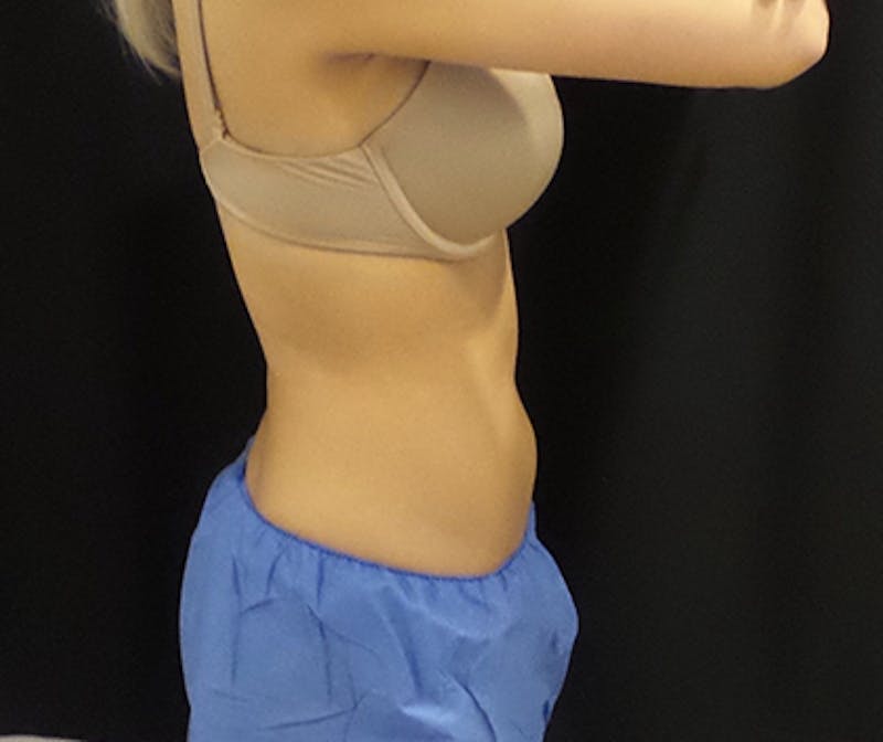 CoolSculpting Before & After Gallery - Patient 191796 - Image 2