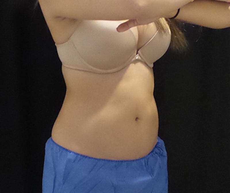 CoolSculpting Before & After Gallery - Patient 191796 - Image 3