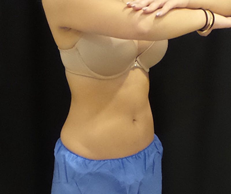 CoolSculpting Before & After Gallery - Patient 191796 - Image 4