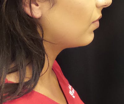 CoolSculpting Before & After Gallery - Patient 161863 - Image 1