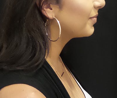 CoolSculpting Before & After Gallery - Patient 161863 - Image 2