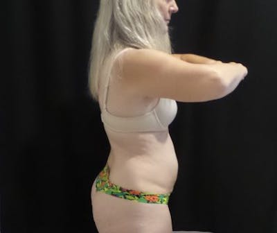 CoolSculpting Before & After Gallery - Patient 218330 - Image 1