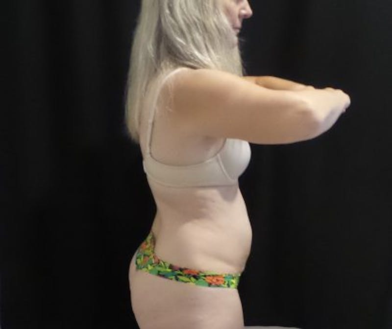 CoolSculpting Before & After Gallery - Patient 218330 - Image 1