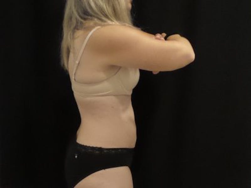 CoolSculpting Before & After Gallery - Patient 218330 - Image 2