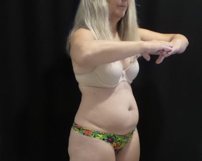 CoolSculpting Before & After Gallery - Patient 218330 - Image 5