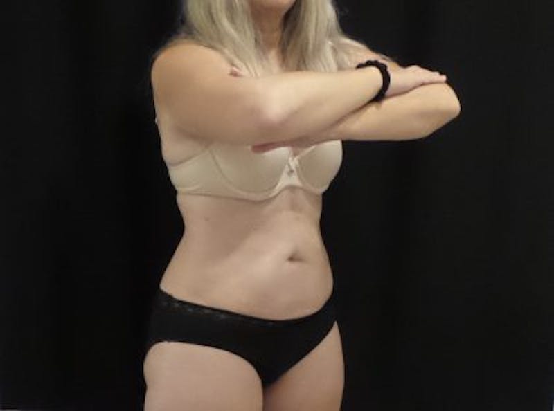 CoolSculpting Before & After Gallery - Patient 218330 - Image 6