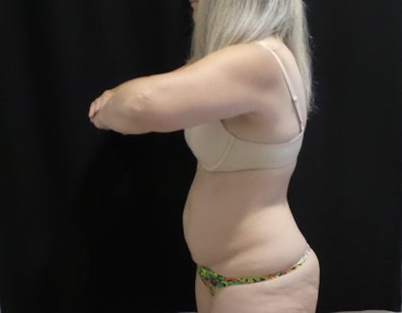 CoolSculpting Before & After Gallery - Patient 218330 - Image 7