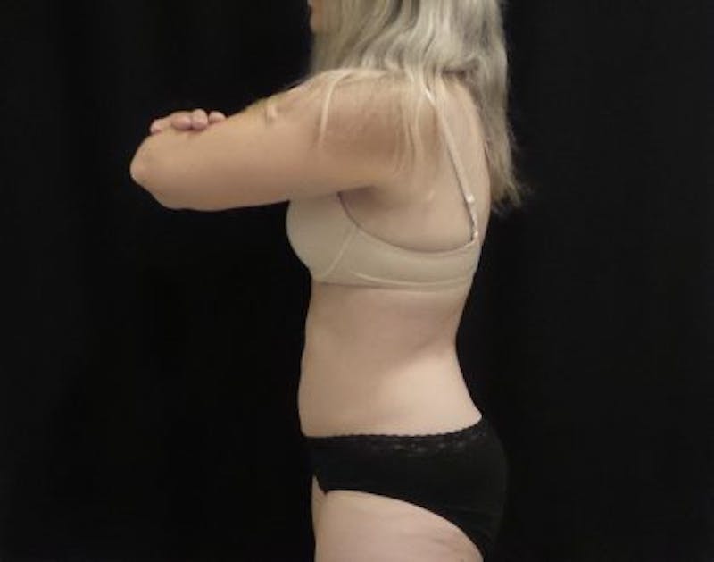 CoolSculpting Before & After Gallery - Patient 218330 - Image 8