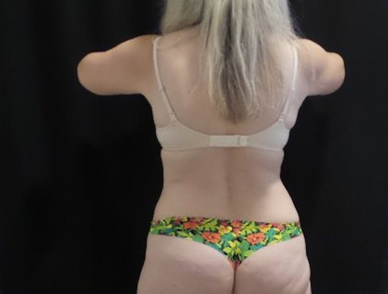 CoolSculpting Before & After Gallery - Patient 218330 - Image 9