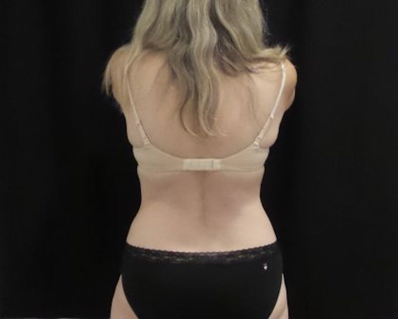 CoolSculpting Before & After Gallery - Patient 218330 - Image 10