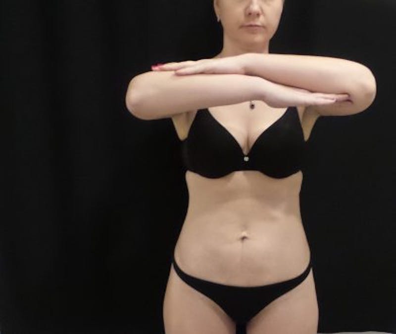 CoolSculpting Before & After Gallery - Patient 173280 - Image 2