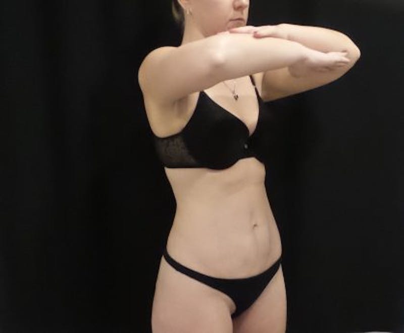 CoolSculpting Before & After Gallery - Patient 173280 - Image 4