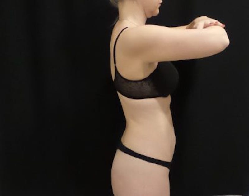 CoolSculpting Before & After Gallery - Patient 173280 - Image 6