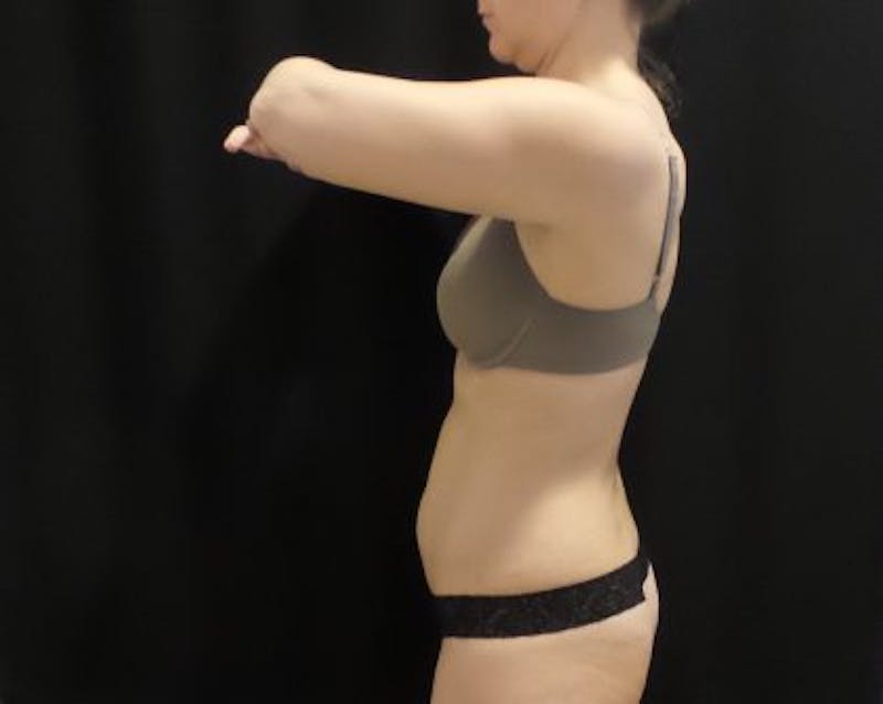CoolSculpting Before & After Gallery - Patient 173280 - Image 7