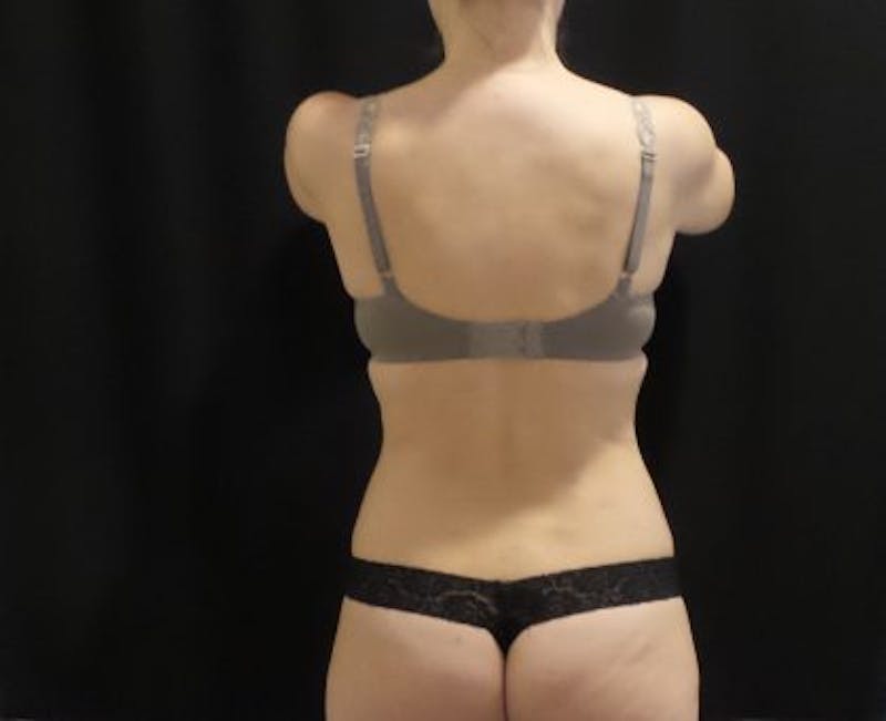 CoolSculpting Before & After Gallery - Patient 173280 - Image 9