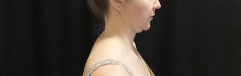 CoolSculpting Before & After Gallery - Patient 173280 - Image 13