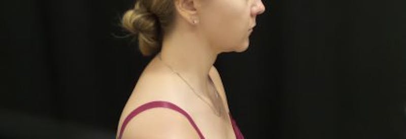 CoolSculpting Before & After Gallery - Patient 173280 - Image 14