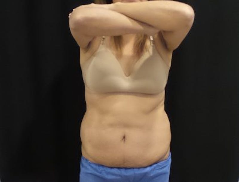 CoolSculpting Before & After Gallery - Patient 158764 - Image 1