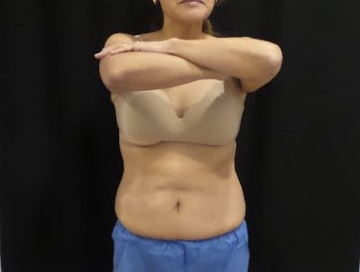 CoolSculpting Before & After Gallery - Patient 158764 - Image 2