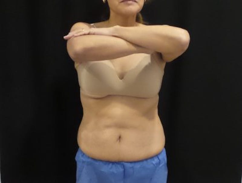 CoolSculpting Before & After Gallery - Patient 158764 - Image 2