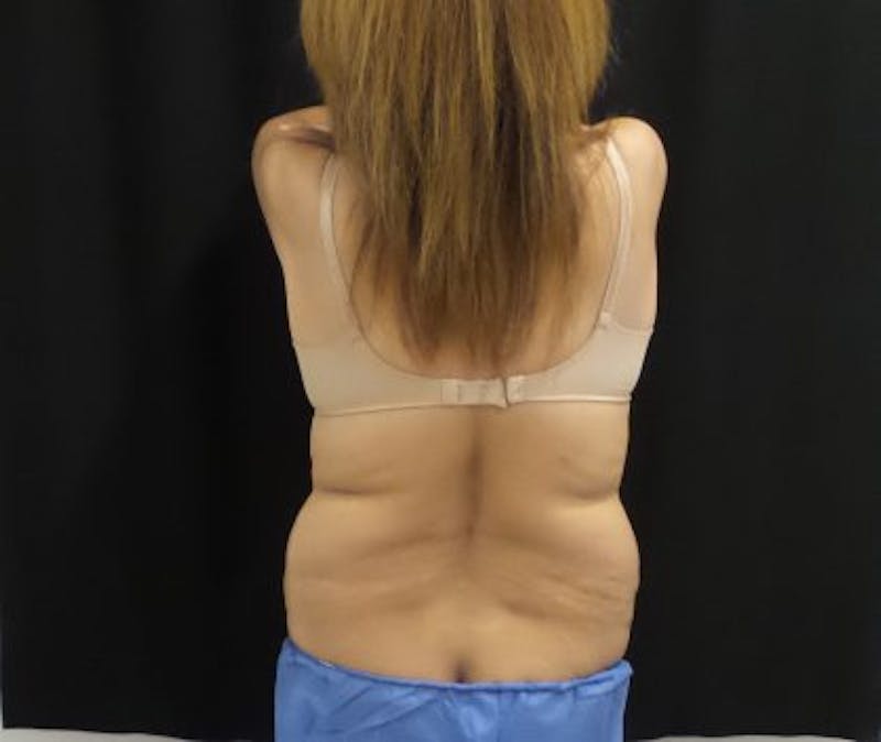 CoolSculpting Before & After Gallery - Patient 158764 - Image 3