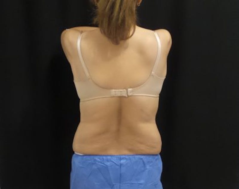 CoolSculpting Before & After Gallery - Patient 158764 - Image 4